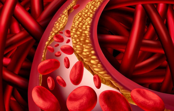 Cục máu đông trong máu sẽ khiến người bệnh dễ mắc đột quỵ